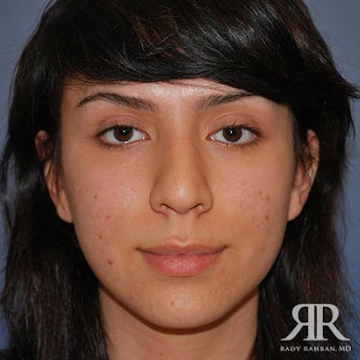 Ethnic Rhinoplasty Before & After Gallery - Patient 247555 - Image 1