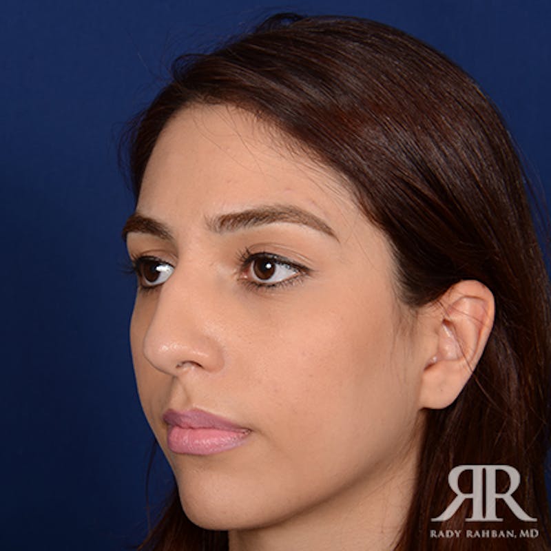 Female Rhinoplasty Before & After Gallery - Patient 142041 - Image 3