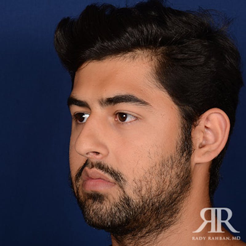 Male Rhinoplasty Before & After Gallery - Patient 109639 - Image 3
