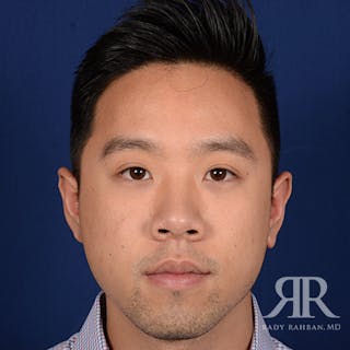 Ear Pinning Surgery Before & After Gallery - Patient 281198 - Image 2