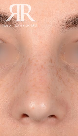 Rhinoplasty Close Up Before & After Gallery - Patient 137029 - Image 4