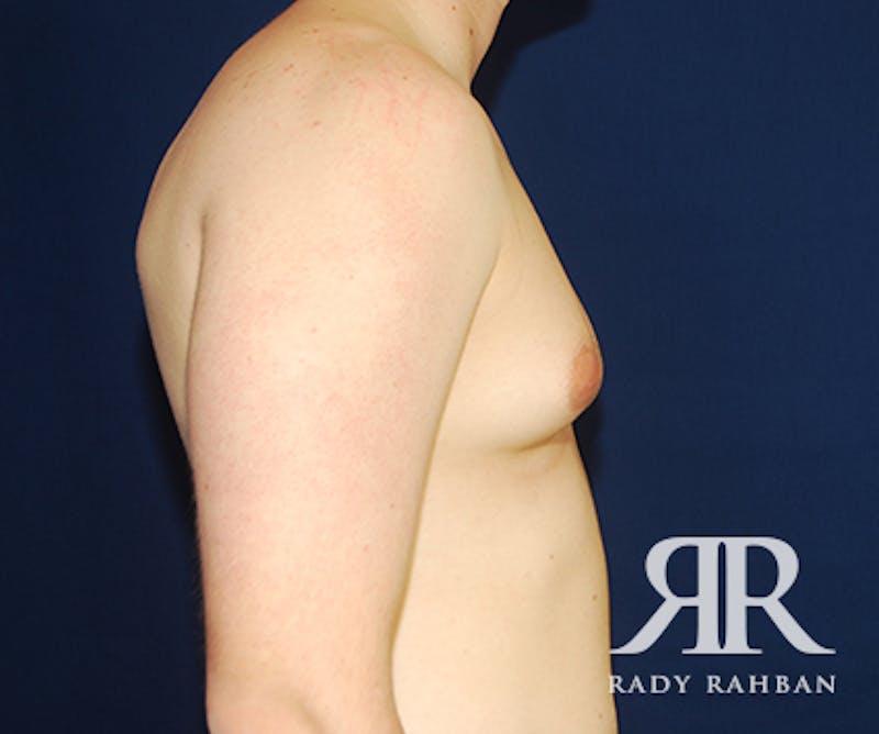 Male Breast Reduction Before & After Gallery - Patient 288166 - Image 3