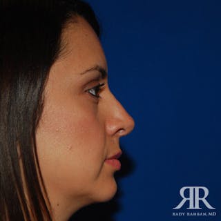 Chin Augmentation Before & After Gallery - Patient 120033 - Image 4