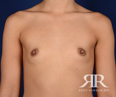 Breast Augmentation Before & After Gallery - Patient 197750 - Image 1