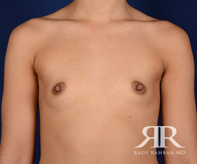Breast Augmentation Before & After Gallery - Patient 197750 - Image 1