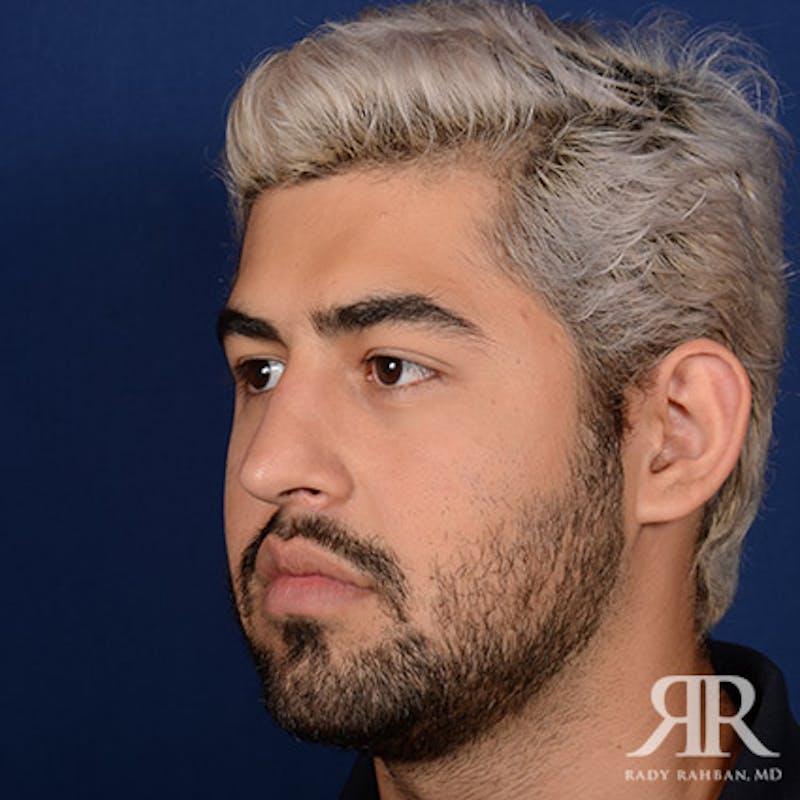 Male Rhinoplasty Before & After Gallery - Patient 109639 - Image 4