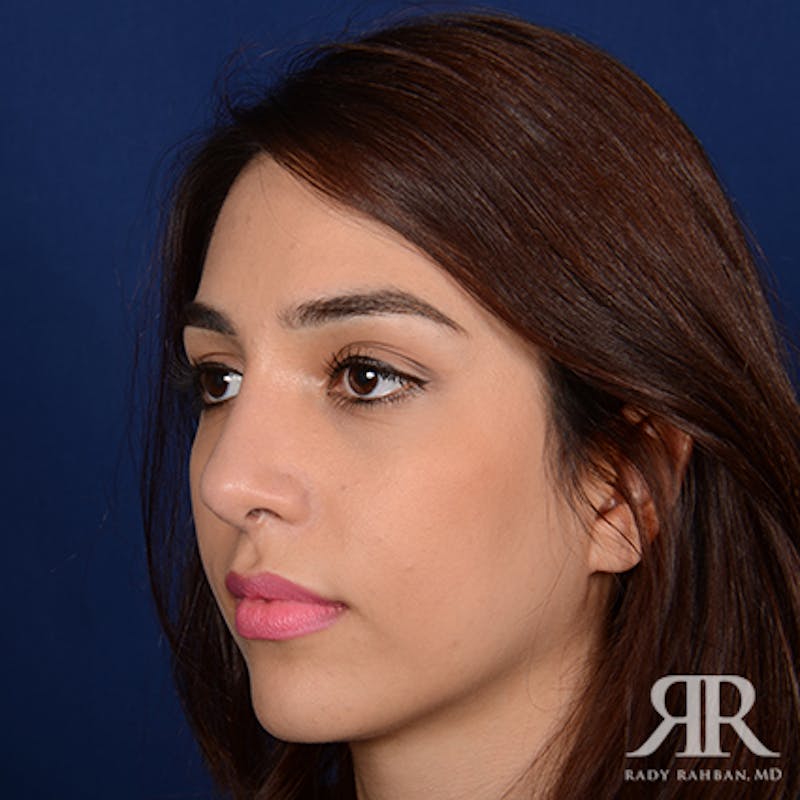 Female Rhinoplasty Before & After Gallery - Patient 142041 - Image 4