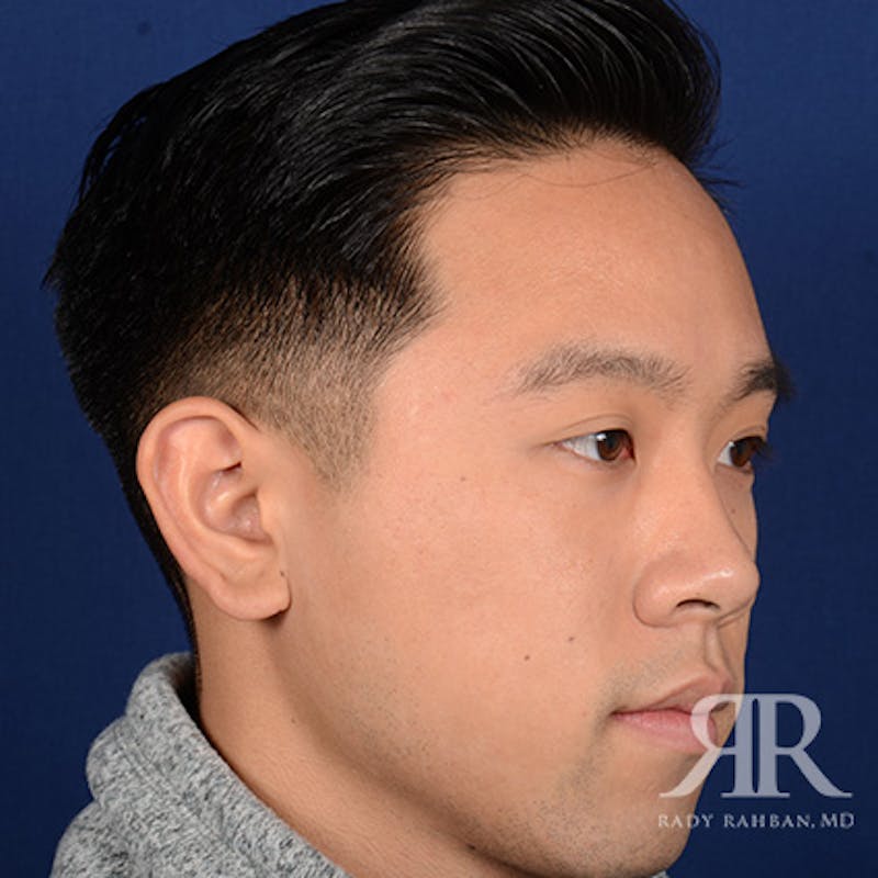 Ear Pinning Surgery Before & After Gallery - Patient 281198 - Image 3