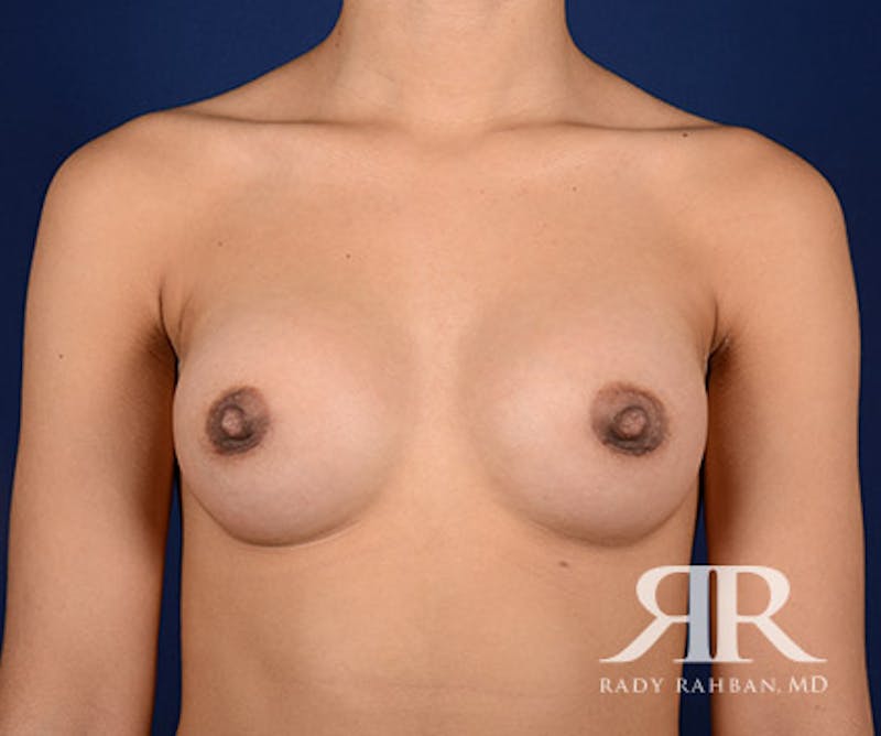 Breast Augmentation Before & After Gallery - Patient 197750 - Image 2