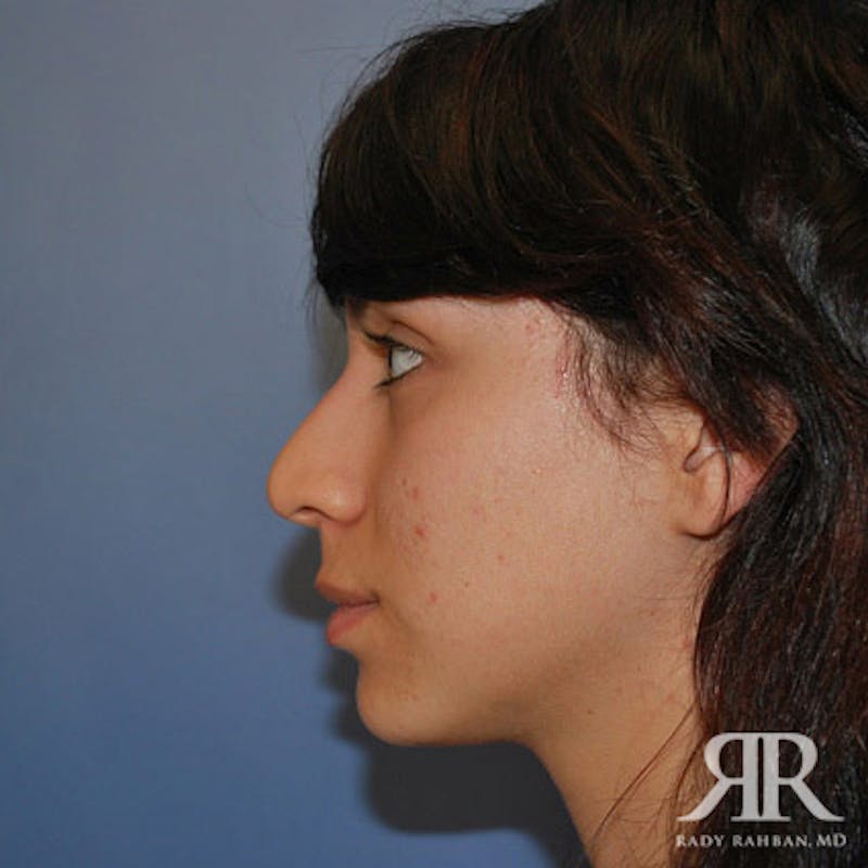 Ethnic Rhinoplasty Before & After Gallery - Patient 247555 - Image 3
