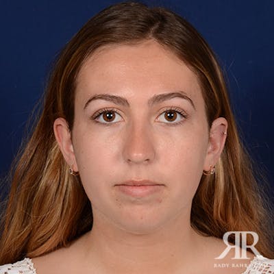 Chin Augmentation Before & After Gallery - Patient 793553 - Image 1