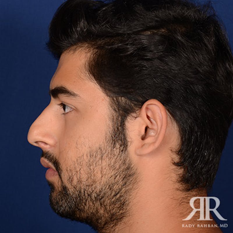 Male Rhinoplasty Before & After Gallery - Patient 109639 - Image 5