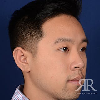 Ear Pinning Surgery Before & After Gallery - Patient 281198 - Image 4