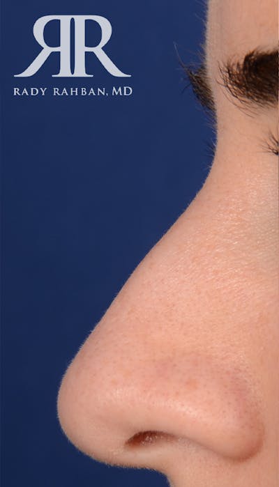 Rhinoplasty Close Up Before & After Gallery - Patient 236527 - Image 1