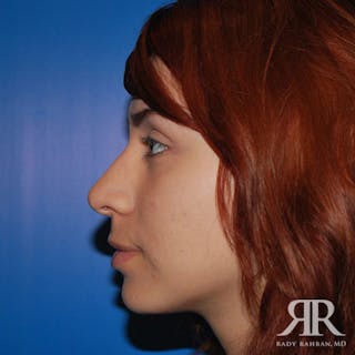 Ethnic Rhinoplasty Before & After Gallery - Patient 247555 - Image 4