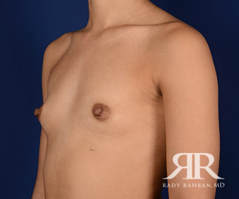 Breast Augmentation Before & After Gallery - Patient 197750 - Image 3