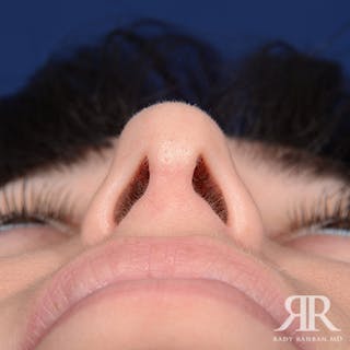 Corrective / Revision Rhinoplasty Before & After Gallery - Patient 260528 - Image 8