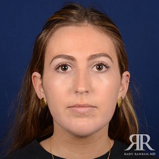 Chin Augmentation Before & After Gallery - Patient 793553 - Image 2