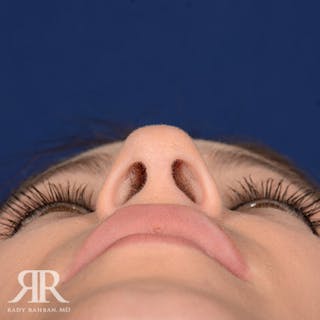 Rhinoplasty w/ Chin Implant Before & After Gallery - Patient 241106 - Image 8