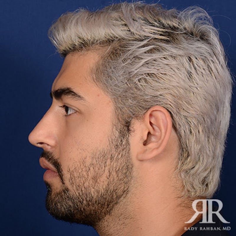 Male Rhinoplasty Before & After Gallery - Patient 109639 - Image 6