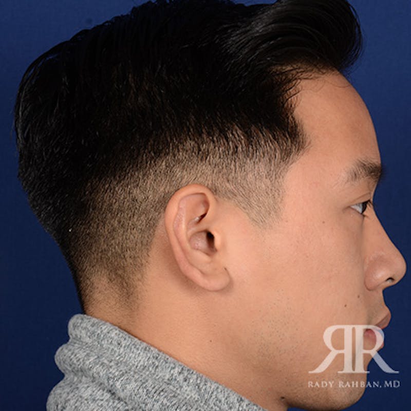 Ear Pinning Surgery Before & After Gallery - Patient 281198 - Image 5