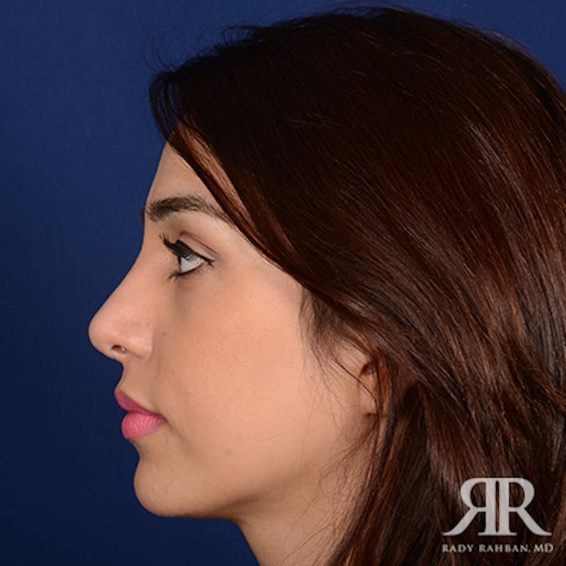 Female Rhinoplasty Before & After Gallery - Patient 142041 - Image 6