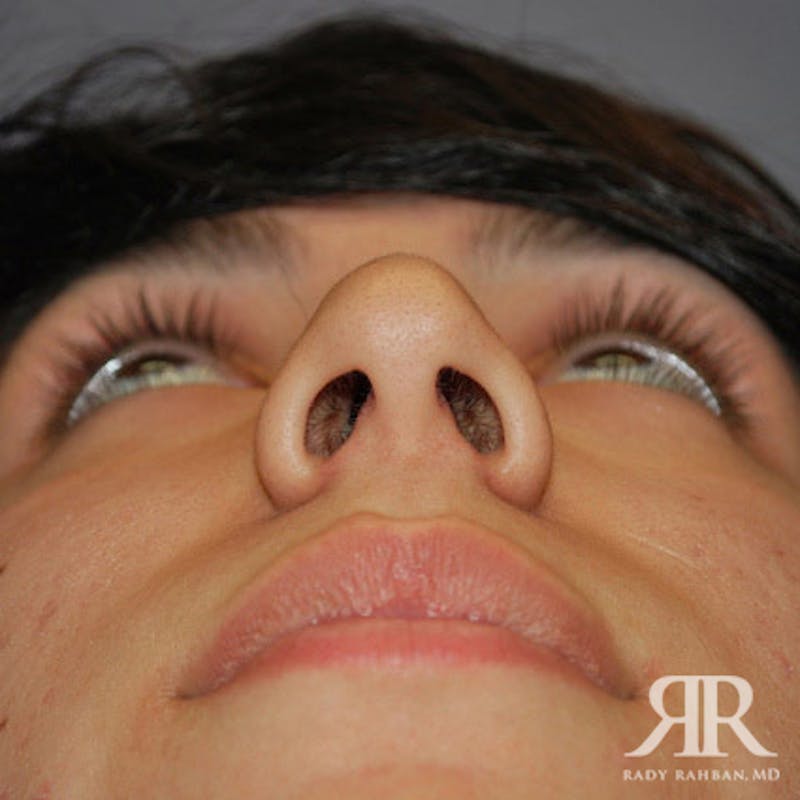 Ethnic Rhinoplasty Before & After Gallery - Patient 247555 - Image 5