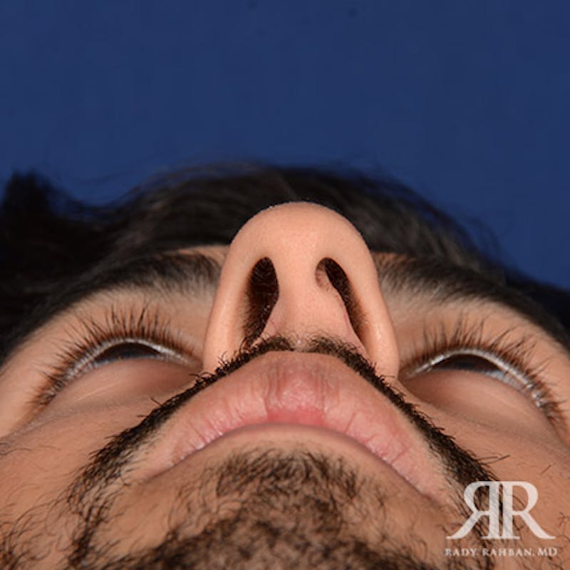 Male Rhinoplasty Before & After Gallery - Patient 109639 - Image 7