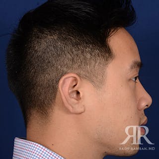 Ear Pinning Surgery Before & After Gallery - Patient 281198 - Image 6