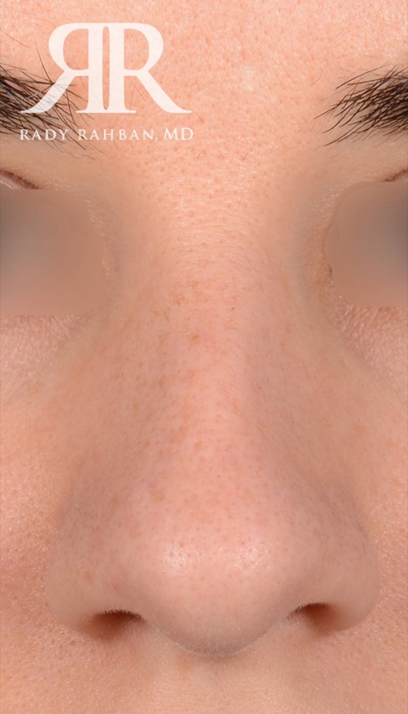 Rhinoplasty Close Up Before & After Gallery - Patient 236527 - Image 3