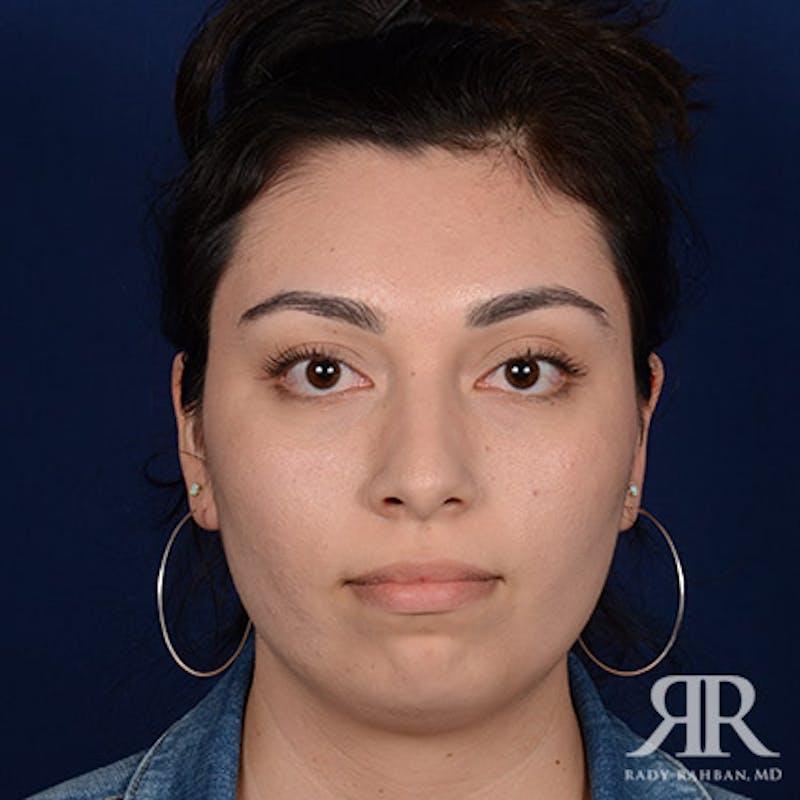 Rhinoplasty w/ Chin Implant Before & After Gallery - Patient 561437 - Image 1