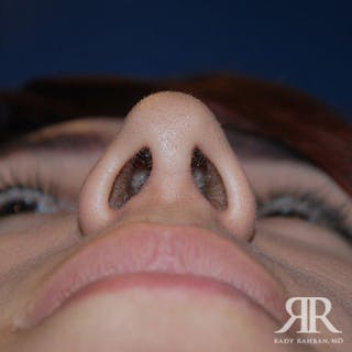 Ethnic Rhinoplasty Before & After Gallery - Patient 247555 - Image 6