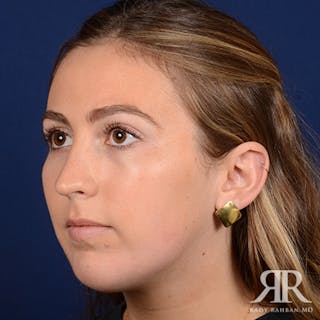Chin Augmentation Before & After Gallery - Patient 793553 - Image 4