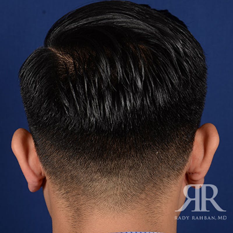 Ear Pinning Surgery Before & After Gallery - Patient 281198 - Image 7