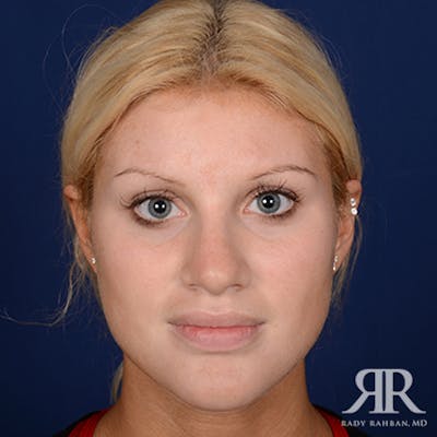 Corrective / Revision Rhinoplasty Before & After Gallery - Patient 128646 - Image 2