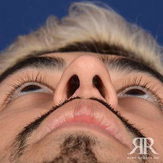 Male Rhinoplasty Before & After Gallery - Patient 109639 - Image 8