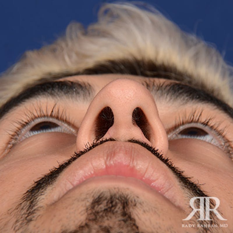 Male Rhinoplasty Before & After Gallery - Patient 109639 - Image 8