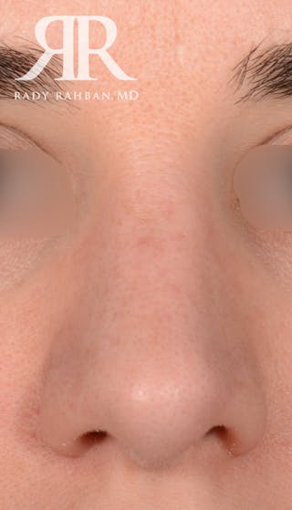 Rhinoplasty Close Up Before & After Gallery - Patient 236527 - Image 4