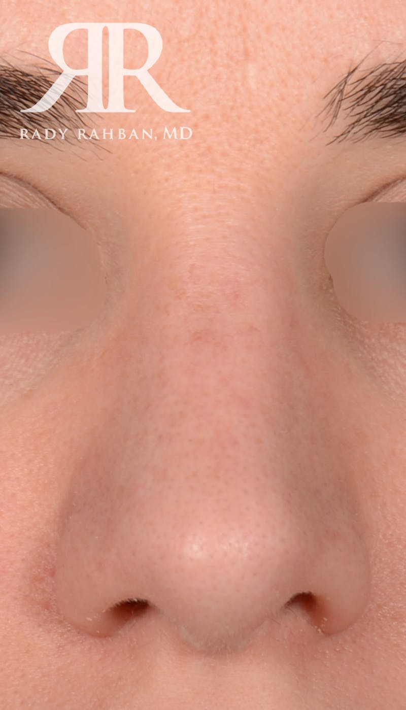 Rhinoplasty Close Up Before & After Gallery - Patient 236527 - Image 4