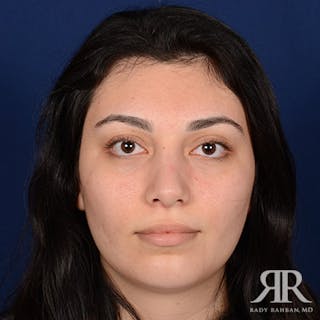Rhinoplasty w/ Chin Implant Before & After Gallery - Patient 561437 - Image 2