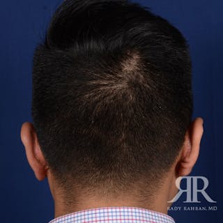 Ear Pinning Surgery Before & After Gallery - Patient 281198 - Image 8