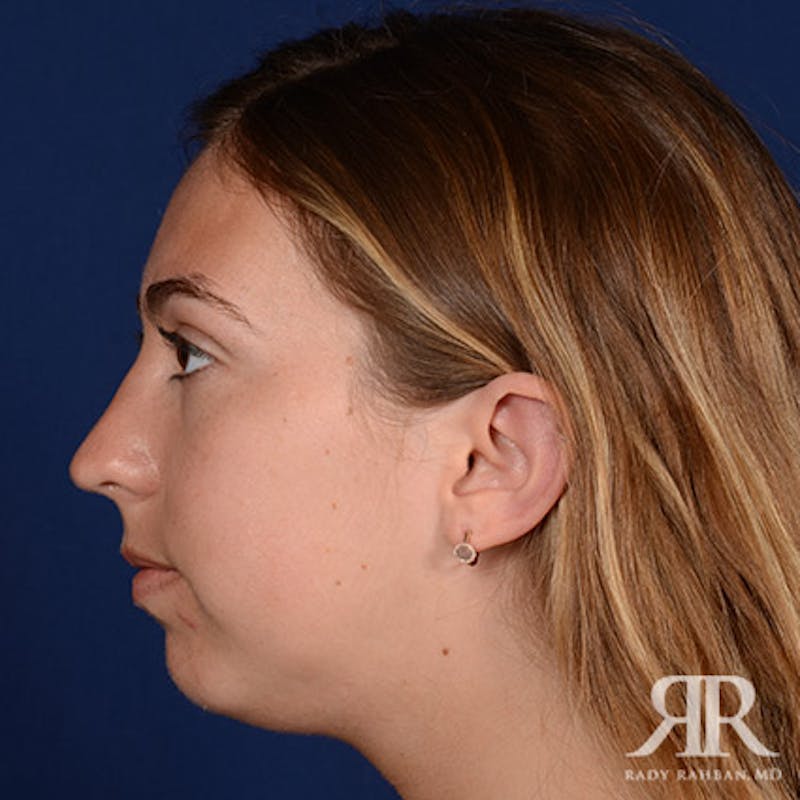 Chin Augmentation Before & After Gallery - Patient 793553 - Image 5
