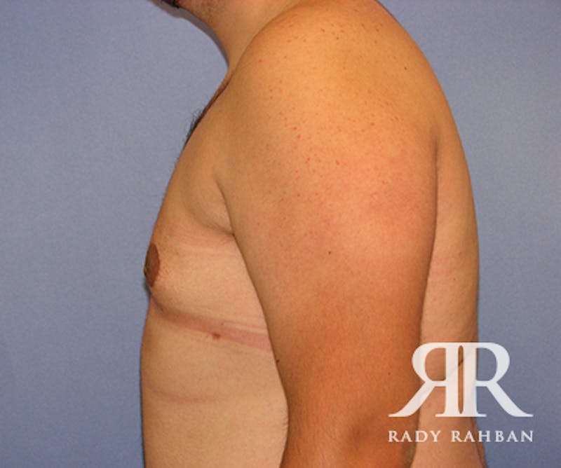 Male Breast Reduction Before & After Gallery - Patient 126486 - Image 4