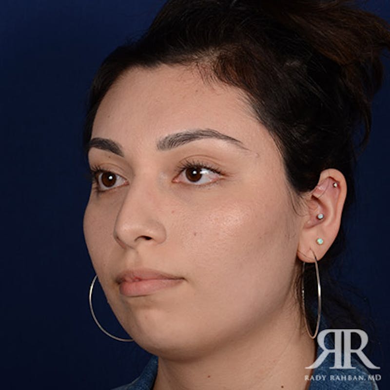 Rhinoplasty w/ Chin Implant Before & After Gallery - Patient 561437 - Image 3