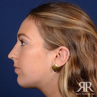Chin Augmentation Before & After Gallery - Patient 793553 - Image 6