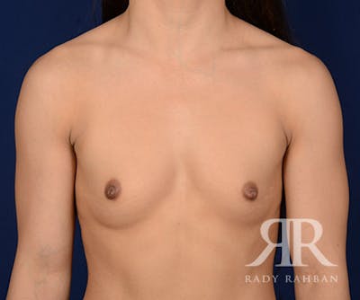 Breast Augmentation Before & After Gallery - Patient 168967 - Image 1