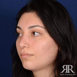 Rhinoplasty w/ Chin Implant Before & After Gallery - Patient 561437 - Image 4