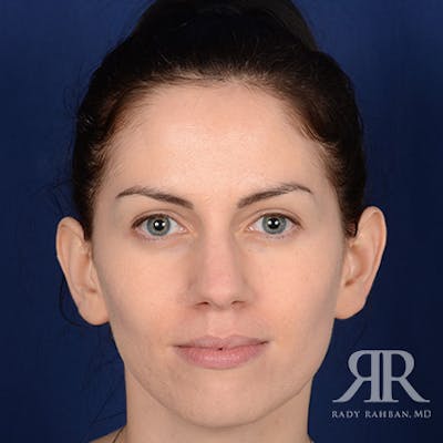 Ear Pinning Surgery Before & After Gallery - Patient 172540 - Image 1