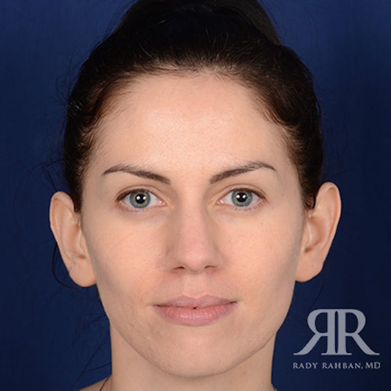 Ear Pinning Surgery Before & After Gallery - Patient 172540 - Image 1