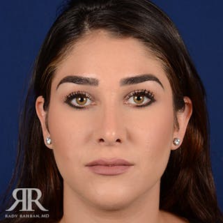 Female Rhinoplasty Before & After Gallery - Patient 129545 - Image 2